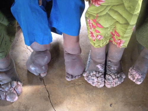 New Initiative Shines Spotlight on Tropical Foot Disease