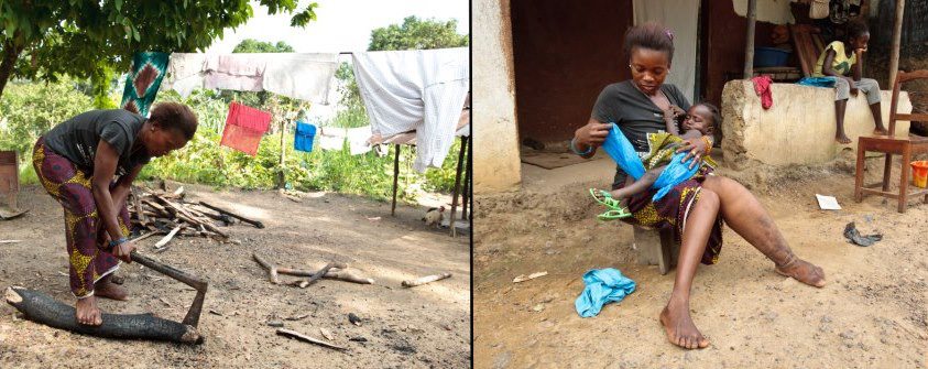 Help Free Sierra Leone from Its Elephantiasis&nbsp;Epidemic